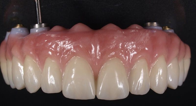 высоко эстетичный зубной ряд "все на 4 | all-on-4" с имитацией десны