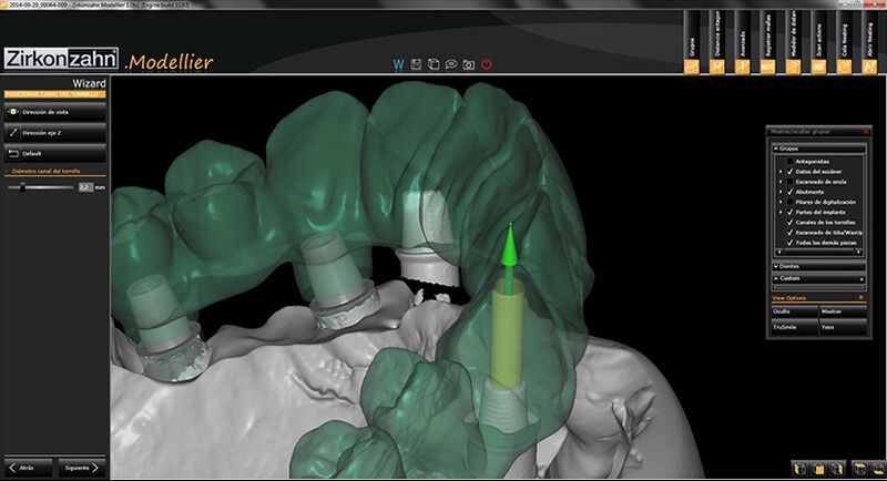 3D моделирование имплантатов и протеза "все на 4 | all-on-4"